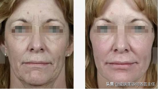 热玛吉有必要做么,热玛吉适用于什么人群