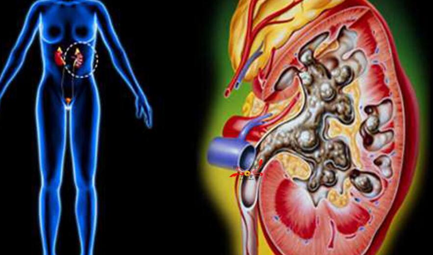 肾结石的四种常见症状一定要认清,肾结石的这些症状切不可忽视