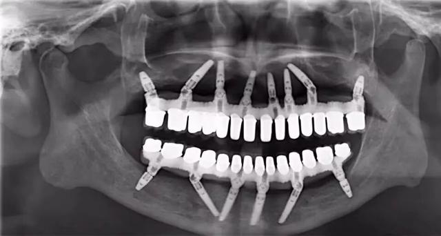 上午种牙下午就能用,上午种植牙下午就可以吃饭