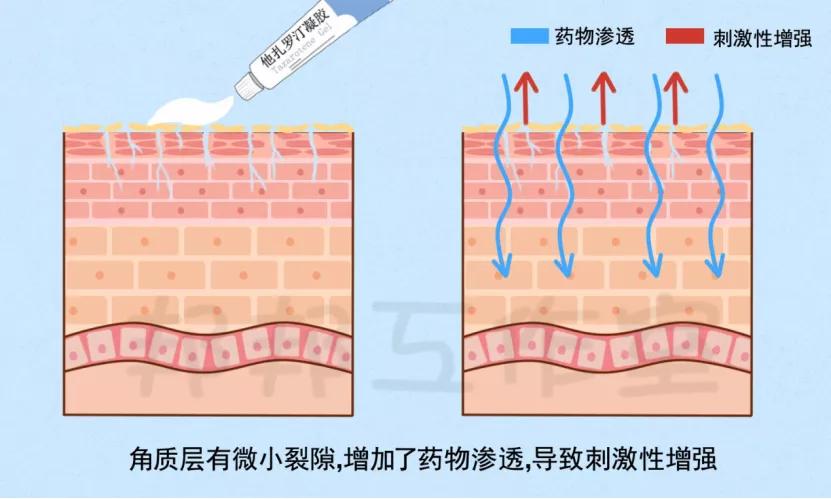 他扎罗汀乳膏抗衰老,他扎罗汀祛痘坑的原理