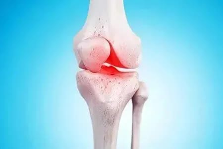 膝关节退行性关节炎怎么治疗,膝关节退行性关节炎缓解方法