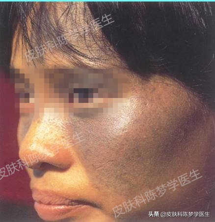 褐青色痣斑吃什么中药好,如何治疗脸上褐青色痣样斑