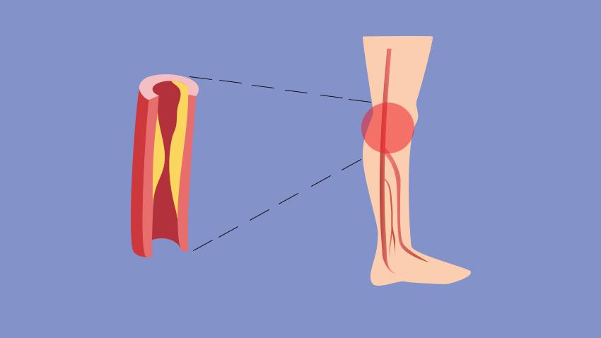 睡觉腿抽筋除了缺钙还有3个原因,睡觉突然腿抽筋是缺钙正确答案