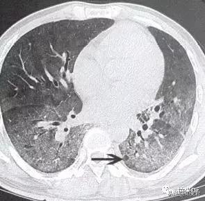 艾滋病患者最易发生的4种真菌感染，其中两种致命性非常高