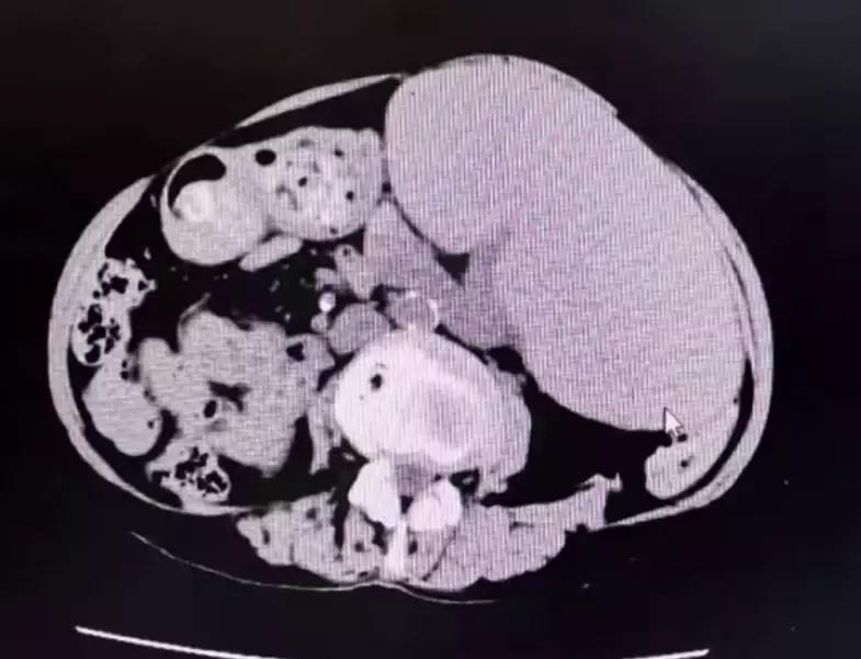 70岁老人胃胀经常腹泻控制不住,75岁老人取出巨脾