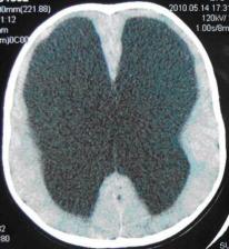 孩子的头偏小怎么办,孩子扁头偏头