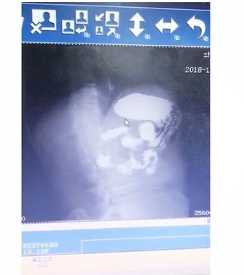 慢性咽炎吃什么药对胃没影响,慢性咽炎是否伴有恶心与胃不舒服