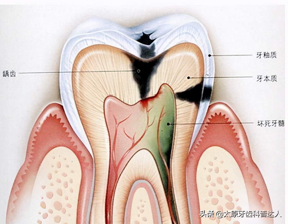 晚上牙痛白天不痛吃什么药,牙齿痛怎么缓解牙痛