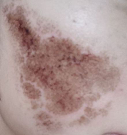 点阵激光能修复到什么程度,点阵激光凹陷疤痕能修复多少