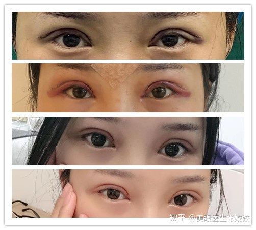 有没有割过眼袋后悔的,肿眼泡割双眼皮后悔率
