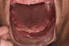 长沙牙齿种植的费用,长沙半口种植牙齿的过程