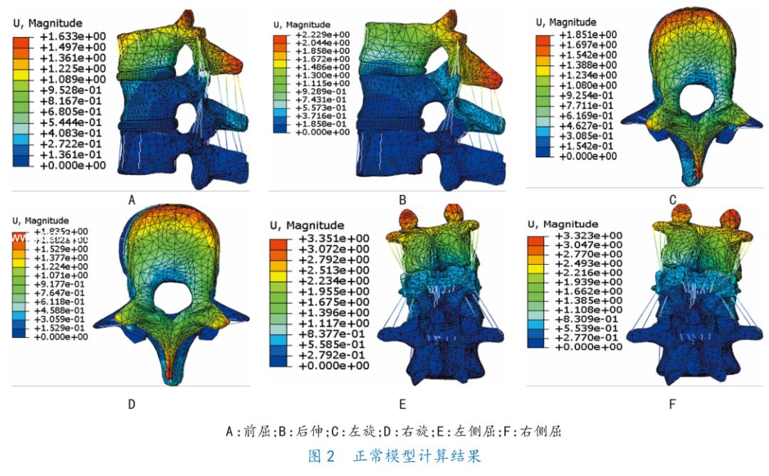 腰1椎体压缩骨折复发要卧床几天,胸12腰4椎体压缩骨折几级工伤