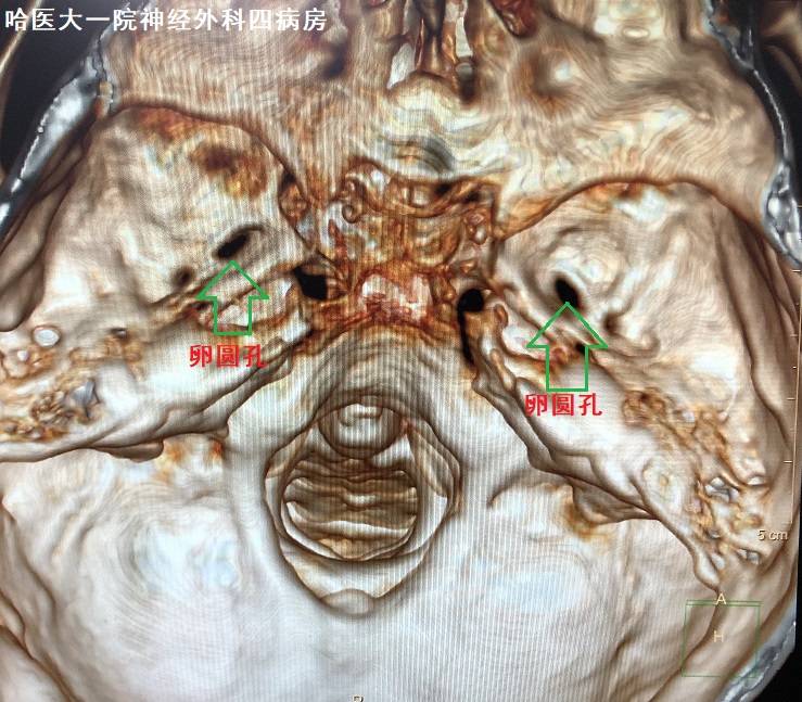 机器人微创手术治疗三叉神经,智能机器人治疗三叉神经痛