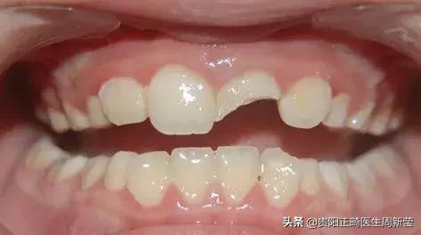 牙齿不好怪父母,儿童口腔不良习惯及矫正