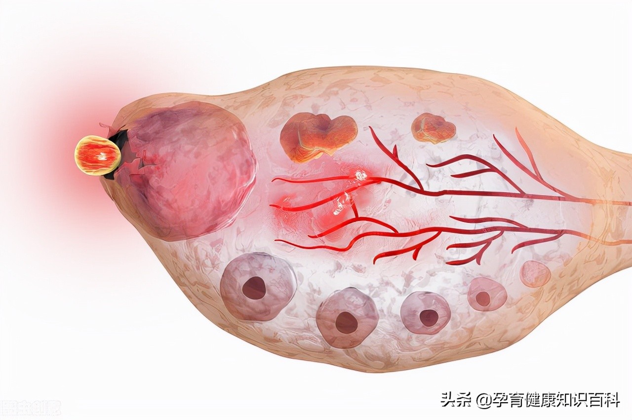 卵泡不排是不是就不能怀孕,卵泡也正常怎么就怀不上孕呢