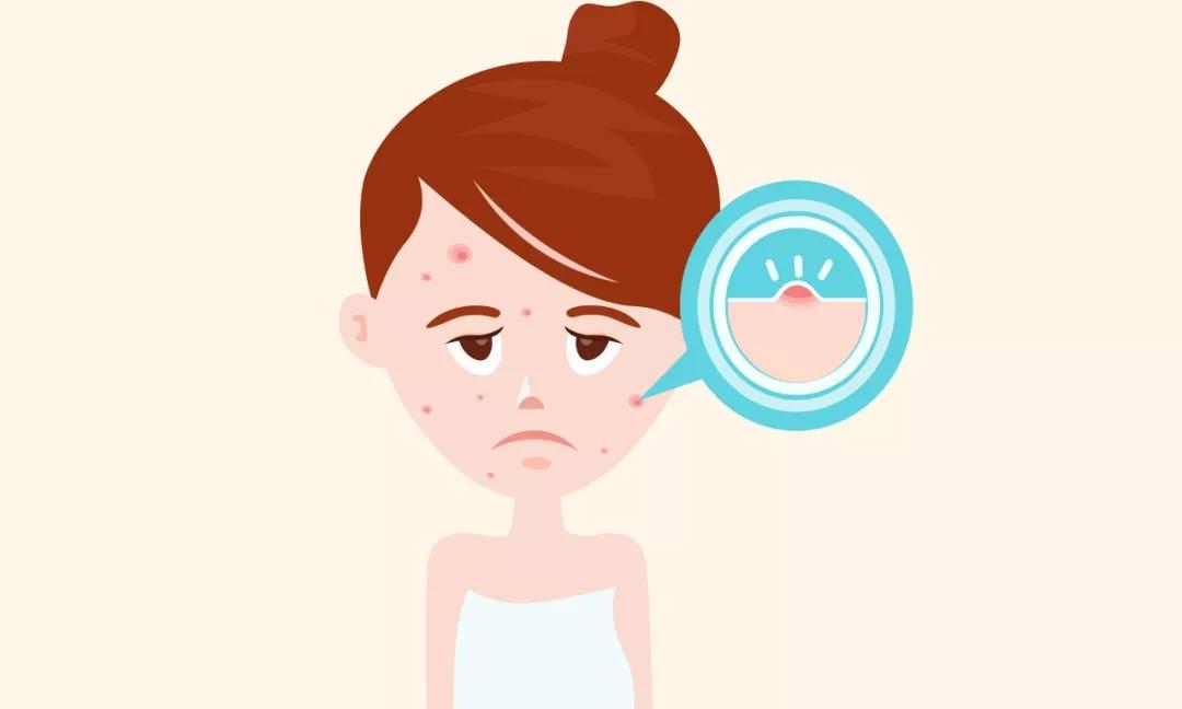 痘痘怎么治都不好不洗脸却好了,痘痘怎么治疗才能彻底治好