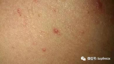 去皮肤科能传染到皮肤病吗,皮肤科传染性皮肤病