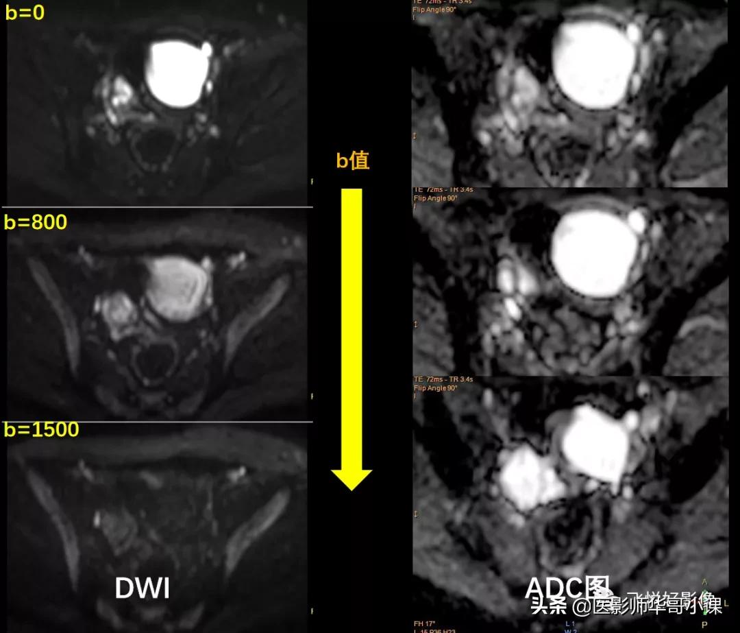 [飞利浦磁共振技术]磁共振扫描下的“女性输卵管成像”，看视频吧