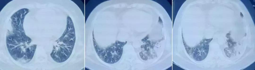 抗菌药物不合理处方分析,抗菌药物用药不合理的表现