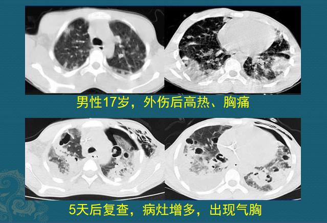 化脓性细菌感染用什么抗生素,化脓性细菌感染有痰用什么抗生素