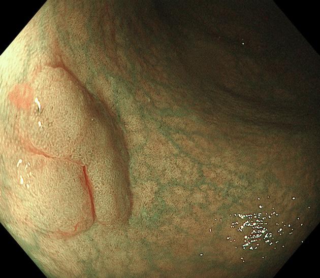 内镜黏膜下肿瘤剥离术,胃镜粘膜下肿瘤剥离术