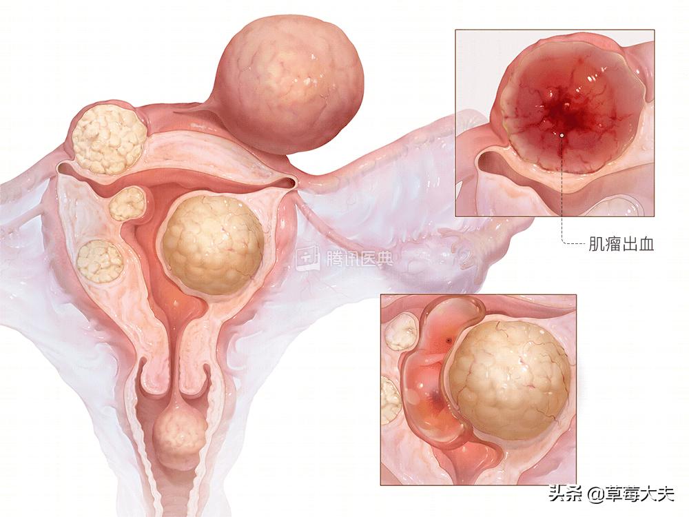 医生也成“催生婆”？不！是你输卵管出问题了......