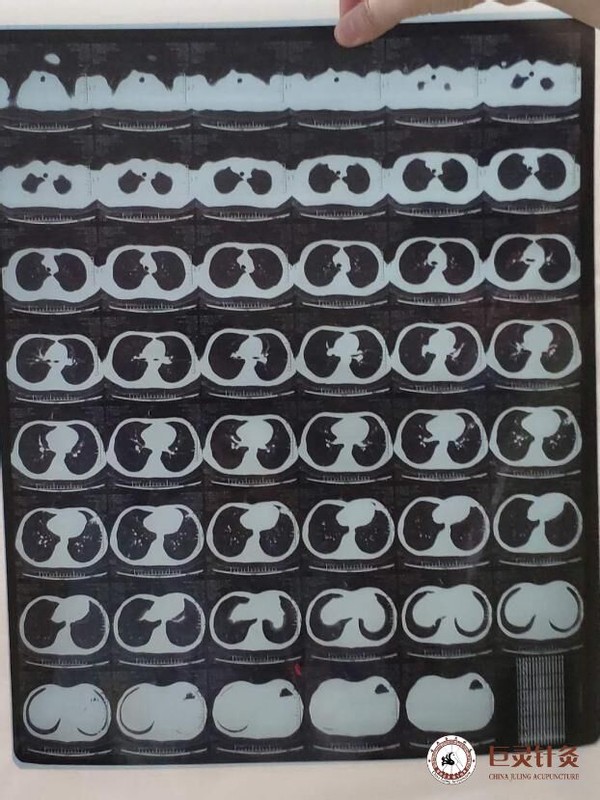 克隆恩氏病中医可以治疗吗,克隆恩氏病治疗费用