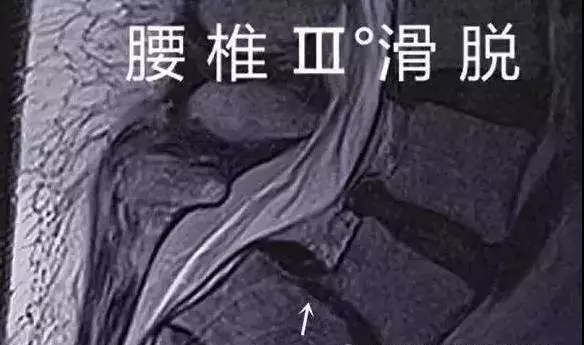 腰椎滑脱坐姿和站姿要注意吗,腰椎滑脱手术拆线后注意事项