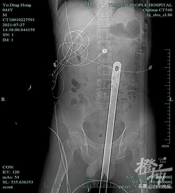 浙江一名男子高空跌落被钢管刺死,男子高处跌落钢管