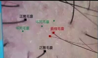 脱发性毛囊炎导致毛囊萎缩,毛囊萎缩脱发是什么样子