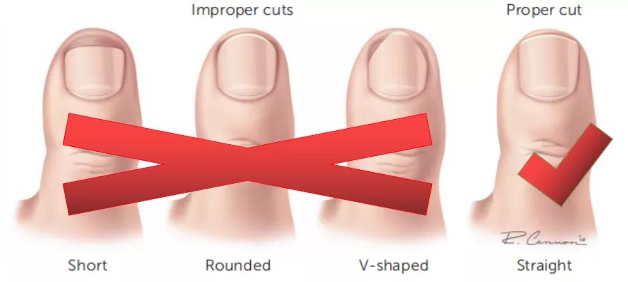 脚食指甲沟炎修甲过程,掌健识健康百科