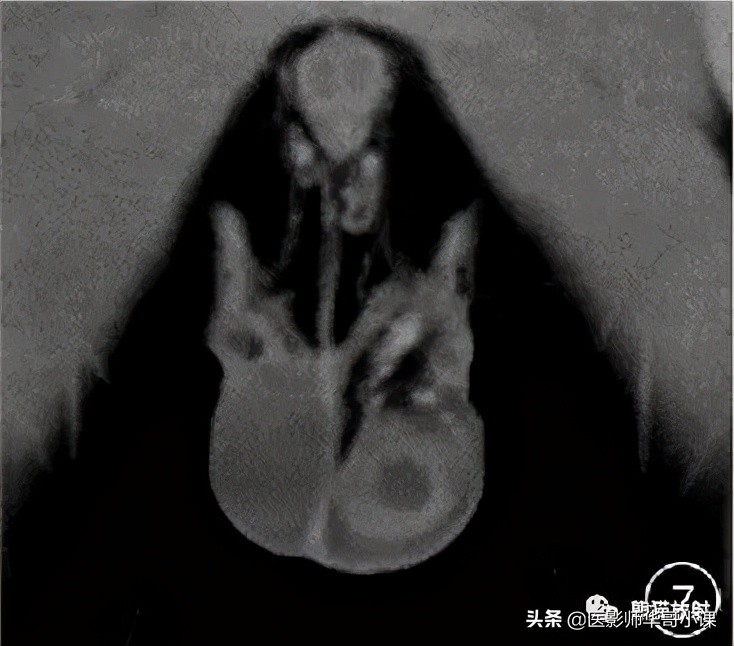 [精品课件]畸胎瘤及精原细胞瘤（*丸睾**肿瘤及肿瘤样变CT及MR表现）