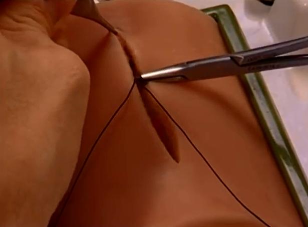 孕妇刀口祛疤痕哪个药膏好用,疤痕体质孕妇剖腹产后疤痕什么样