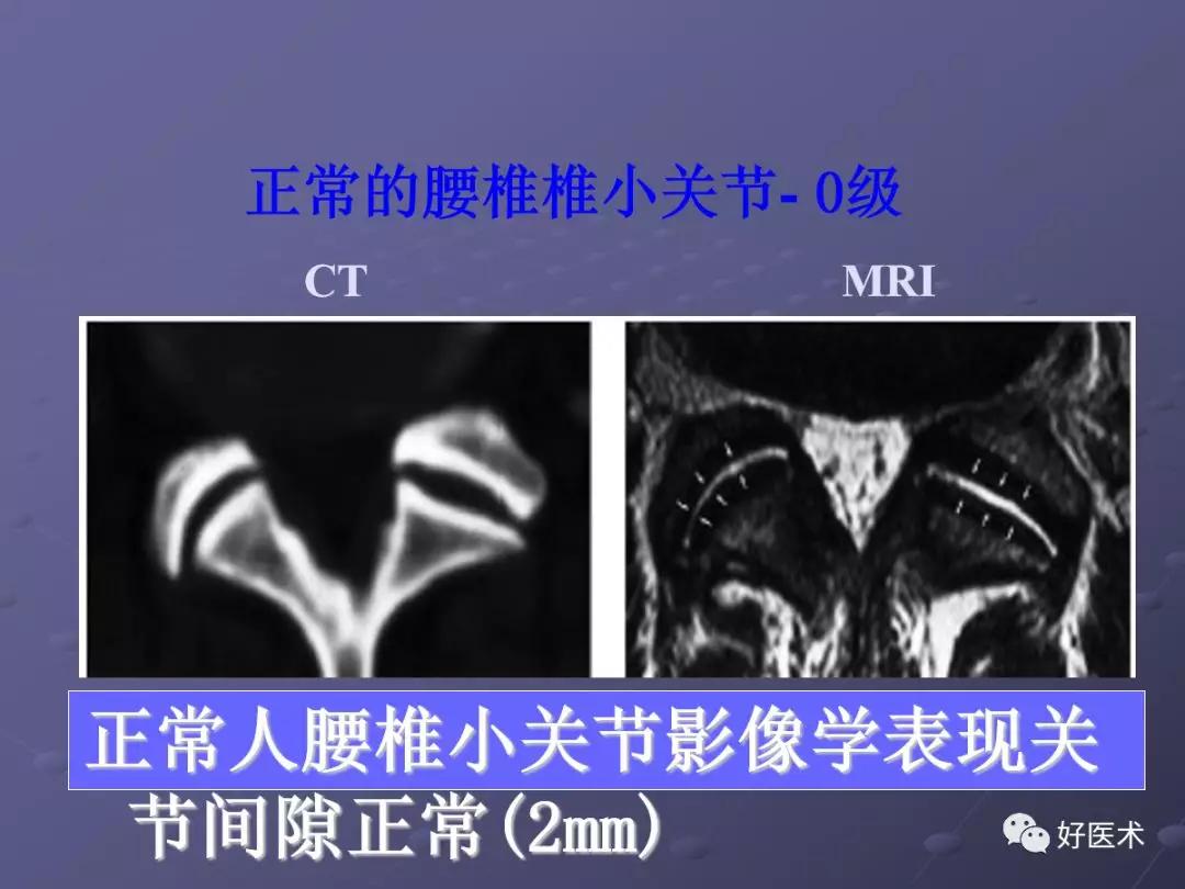 脊柱mri有哪些特点,乳腺疾病的mri诊断及鉴别