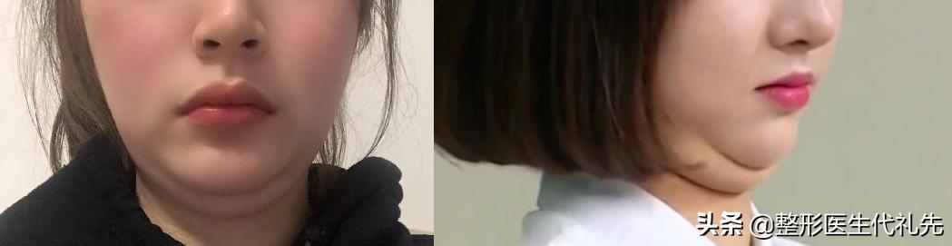 怎样才能拥有完美的下颌线,怎样让自己的下颌线更明显