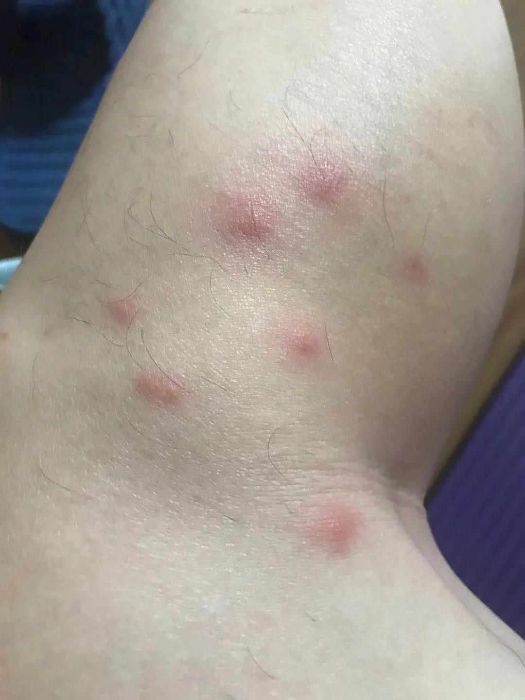 小咬蠓虫天敌,小咬蠓虫照片