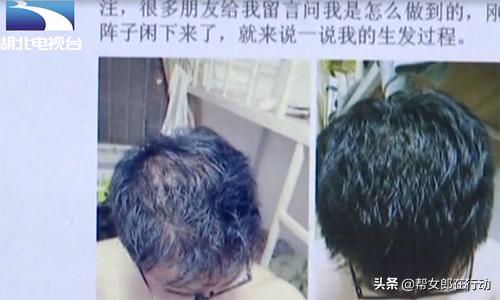 小伙购买生发剂,男人网购生发液头上却长满脓包
