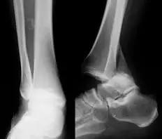 特殊骨折类型,特殊骨折体征