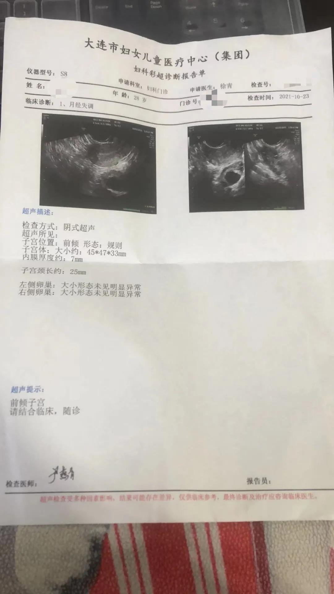 中药治疗多囊卵巢综合征案例,专治多囊卵巢闭经中成药