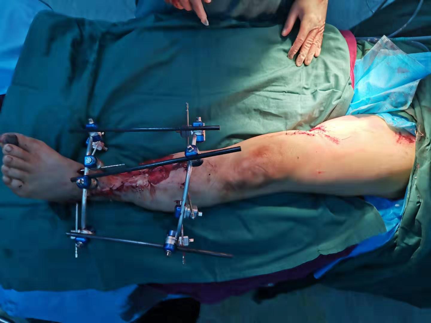 沈医附属中心医院7小时手术为他“留”左脚,这种危险身边还有!