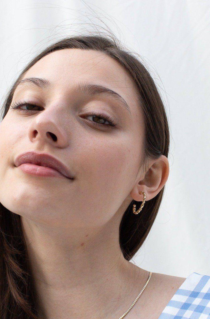 眼周水肿的原因分析,如何改善眼皮浮肿