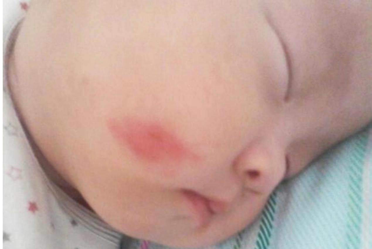 分娩时要不要使用产钳,哪些情况不能用产钳助产