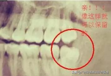 智齿发炎有脓是否需要切开,智齿反复发炎不去拔掉的后果