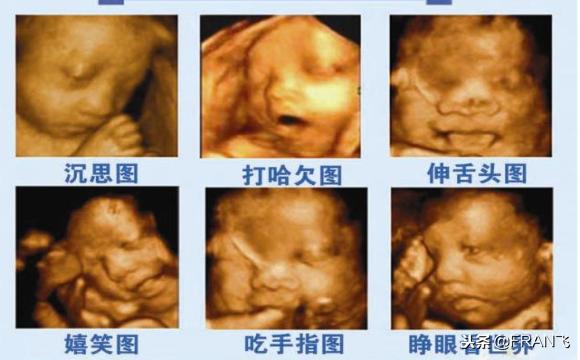 “四维彩超”主要查这些，准妈妈你都知道吗？