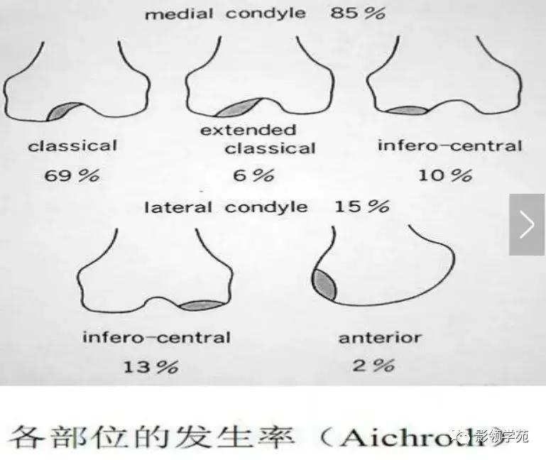 膝关节常见疼痛原因及其缓解方法,膝关节疼痛的16种最常见原因速查