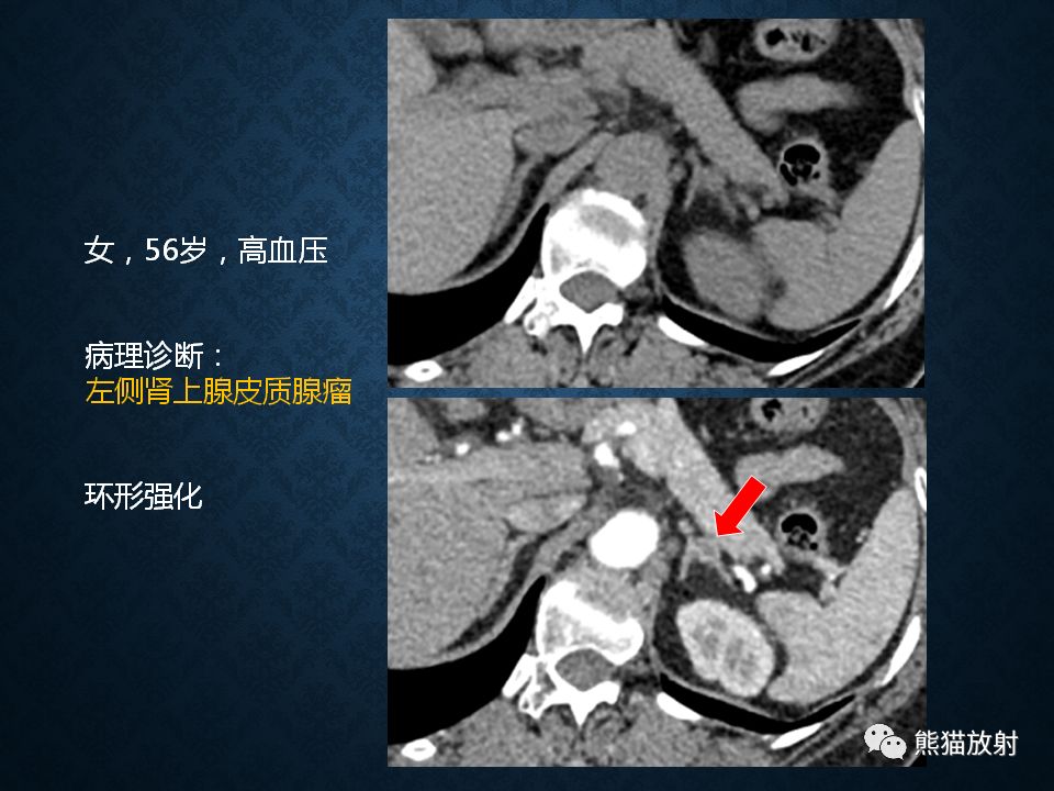 纵隔和肾上腺恶性肿瘤,纵隔性肿瘤位置图