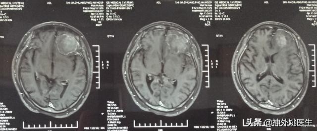 脑膜瘤是什么原因引起的啊,脑膜瘤手术治疗全部大概多少钱