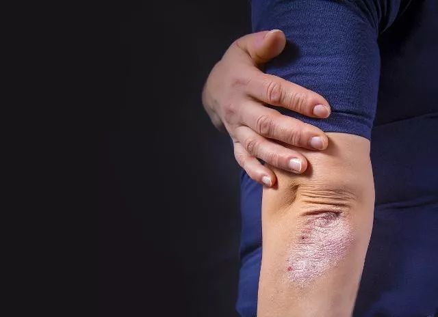 青岛肤研堂银屑病治疗,青岛市肤研堂银屑病治疗时间