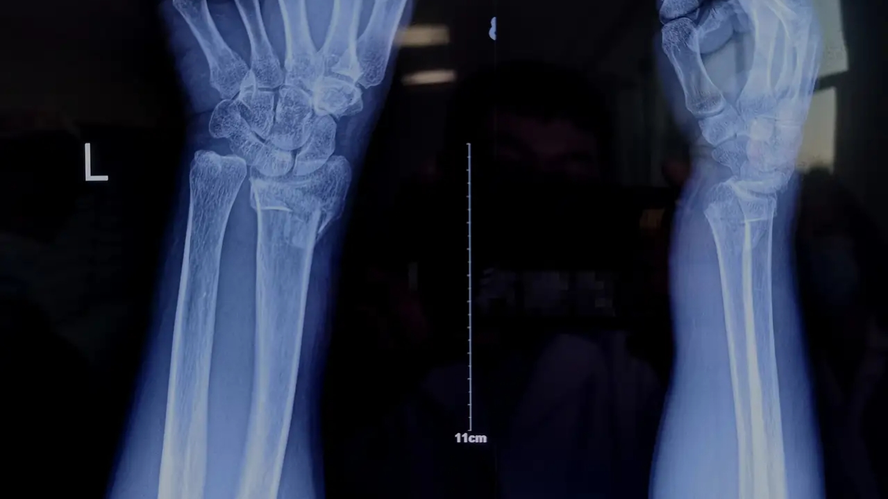 骨折复位后又移位有什么症状,骨折手法复位后容易移位吗