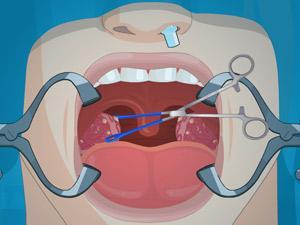 割掉扁桃体影响唱歌吗,割掉扁桃体会影响什么
